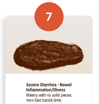 Bristol stool chart type 7 watery diarrhea